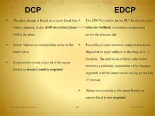 DCP EDCP
 The plate design is based on a screw head that,
when tightened, slides down an inclined plane
within the plate.
 Screw behaves as compression screw or the
static screw
 Compression is not achieved at the upper
border so tension band is required
 The EDCP is similar to the DCP in that the inner
holes are designed to produce compression
across the fracture site
 Two oblique outer eccentric compression holes
aligned at an angle oblique to the long axis of
the plate. The activation of these outer holes
produces a rotational movement of the fracture
segments with the inner screws acting as the axis
of rotation
 Brings compression at the upper border so
tension band is not required
27-04-2016Mandibular Fractures 84
 