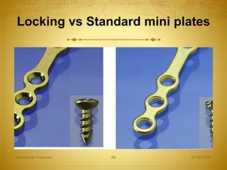 Locking vs Standard mini plates
27-04-2016Mandibular Fractures 89
 