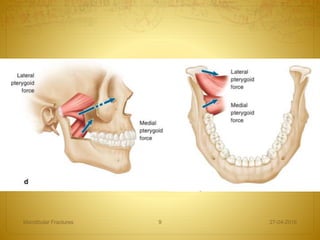 27-04-2016Mandibular Fractures 9
 
