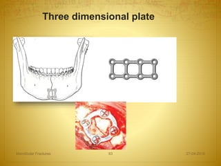 Three dimensional plate
27-04-2016Mandibular Fractures 93
 