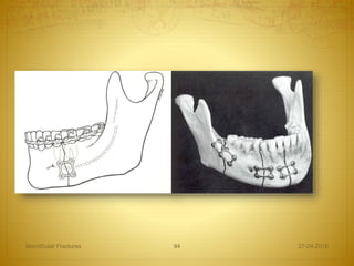 27-04-2016Mandibular Fractures 94
 