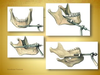 27-04-2016Mandibular Fractures 99
 