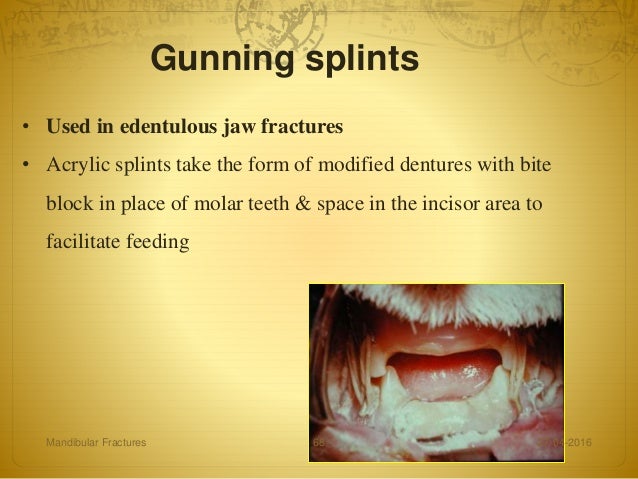 Mandibular fractures
