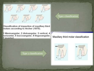 Mandibular3rdmolarimpactions 130421031302-phpapp02 | PPTX