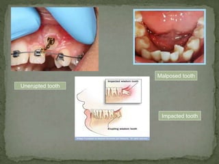 Mandibular3rdmolarimpactions 130421031302-phpapp02 | PPTX