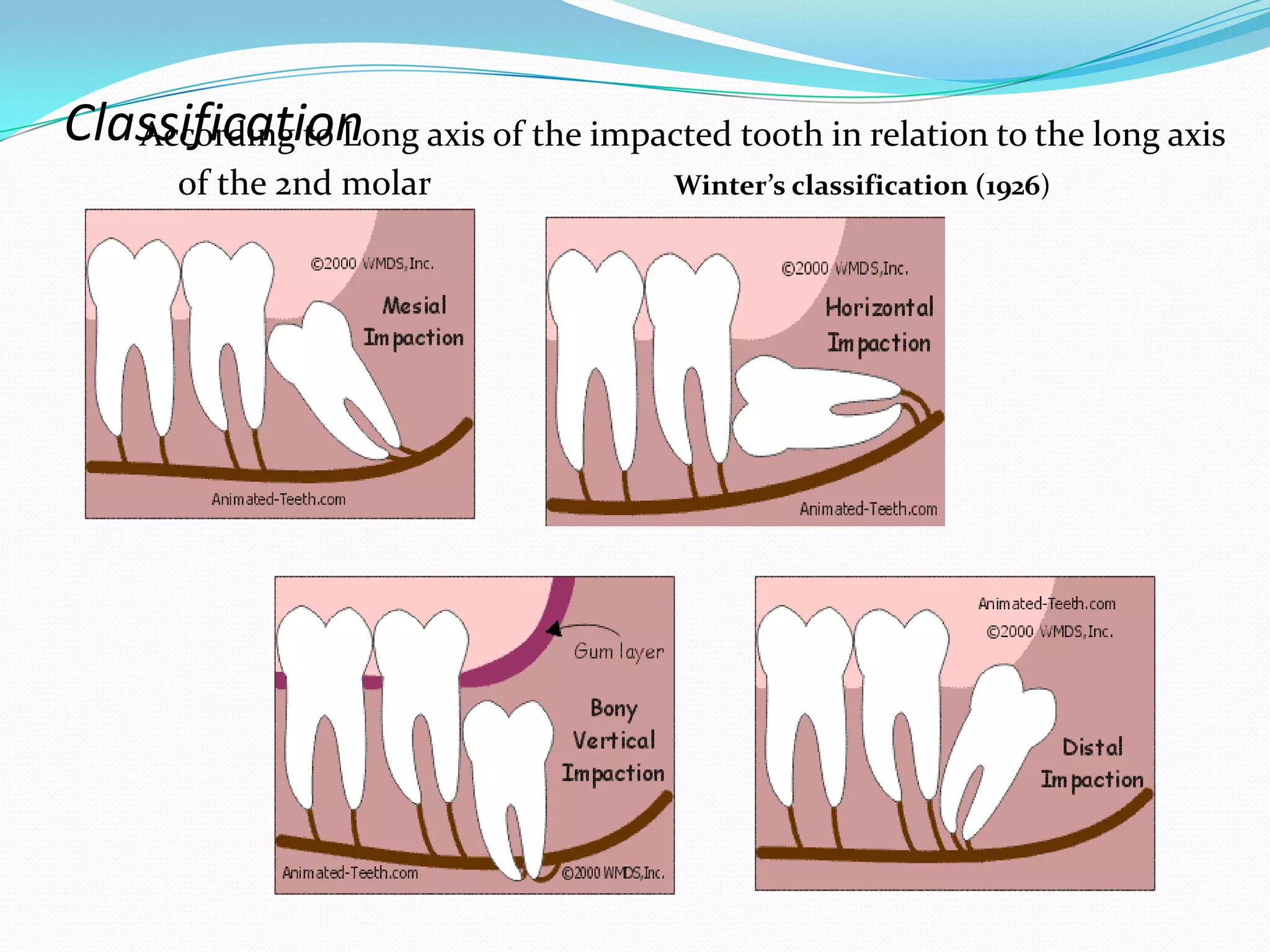 Mandibular 3rd molar impactions | PPTX