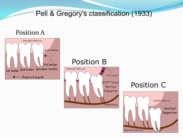 Mandibular 3rd molar impactions | PPTX | Ear, Nose and Throat ...