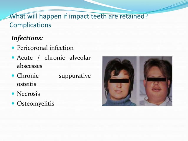 Mandibular 3rd molar impactions | PPTX | Ear, Nose and Throat ...