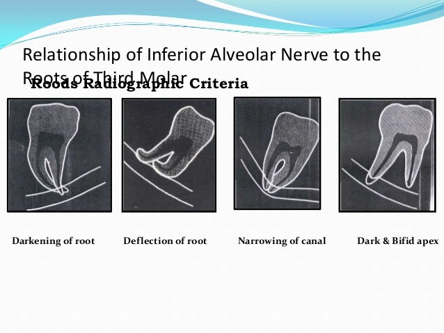 impacted tooth