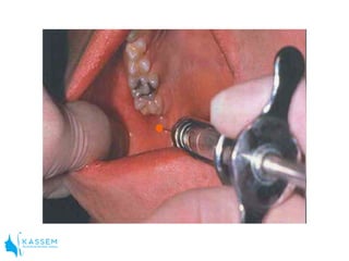 4. Buccal Nerve Block
a) Arises in the infratemporal fossa and crosses
the anterior border of the ramus to give multiple
b...