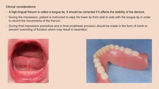 Clinical considerations:
• A high-lingual frenum is called a tongue tie. It should be corrected if it affects the stability of the denture.
• During the impression, patient is instructed to wipe his lower lip from side to side with the tongue tip in order
to record the movements of the frenum.
• During final impression procedure and in final prosthesis provision should be made in the form of notch to
prevent overriding of function which may result in laceration.
 