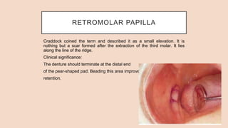 RETROMOLAR PAPILLA
Craddock coined the term and described it as a small elevation. It is
nothing but a scar formed after the extraction of the third molar. It lies
along the line of the ridge.
Clinical significance:
The denture should terminate at the distal end
of the pear-shaped pad. Beading this area improves
retention.
 
