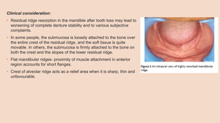 Clinical consideration:
• Residual ridge resorption in the mandible after tooth loss may lead to
worsening of complete denture stability and to various subjective
complaints.
• In some people, the submucosa is loosely attached to the bone over
the entire crest of the residual ridge, and the soft tissue is quite
movable. In others, the submucosa is firmly attached to the bone on
both the crest and the slopes of the lower residual ridge.
• Flat mandibular ridges- proximity of muscle attachment in anterior
region accounts for short flanges.
• Crest of alveolar ridge acts as a relief area when it is sharp, thin and
unfavourable.
 