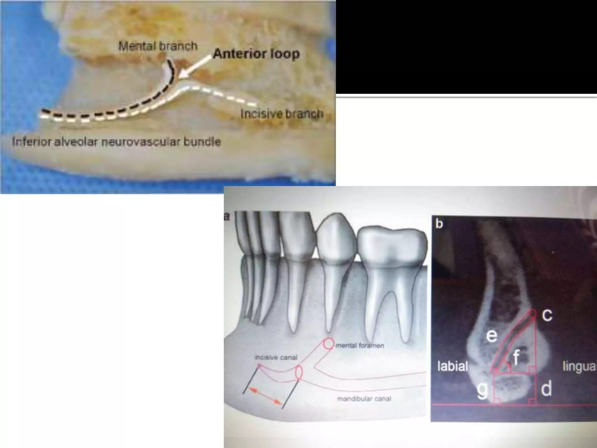Mandibular anatomy for dental implant | PPTX