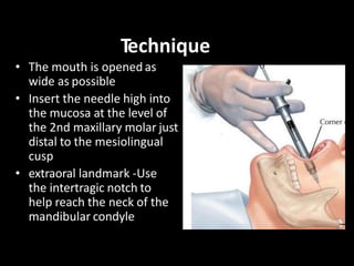 Technique
• The mouth is opened as
wide as possible
• Insert the needle high into
the mucosa at the level of
the 2nd maxil...