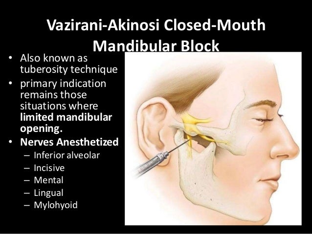 Mandibular anesthesia