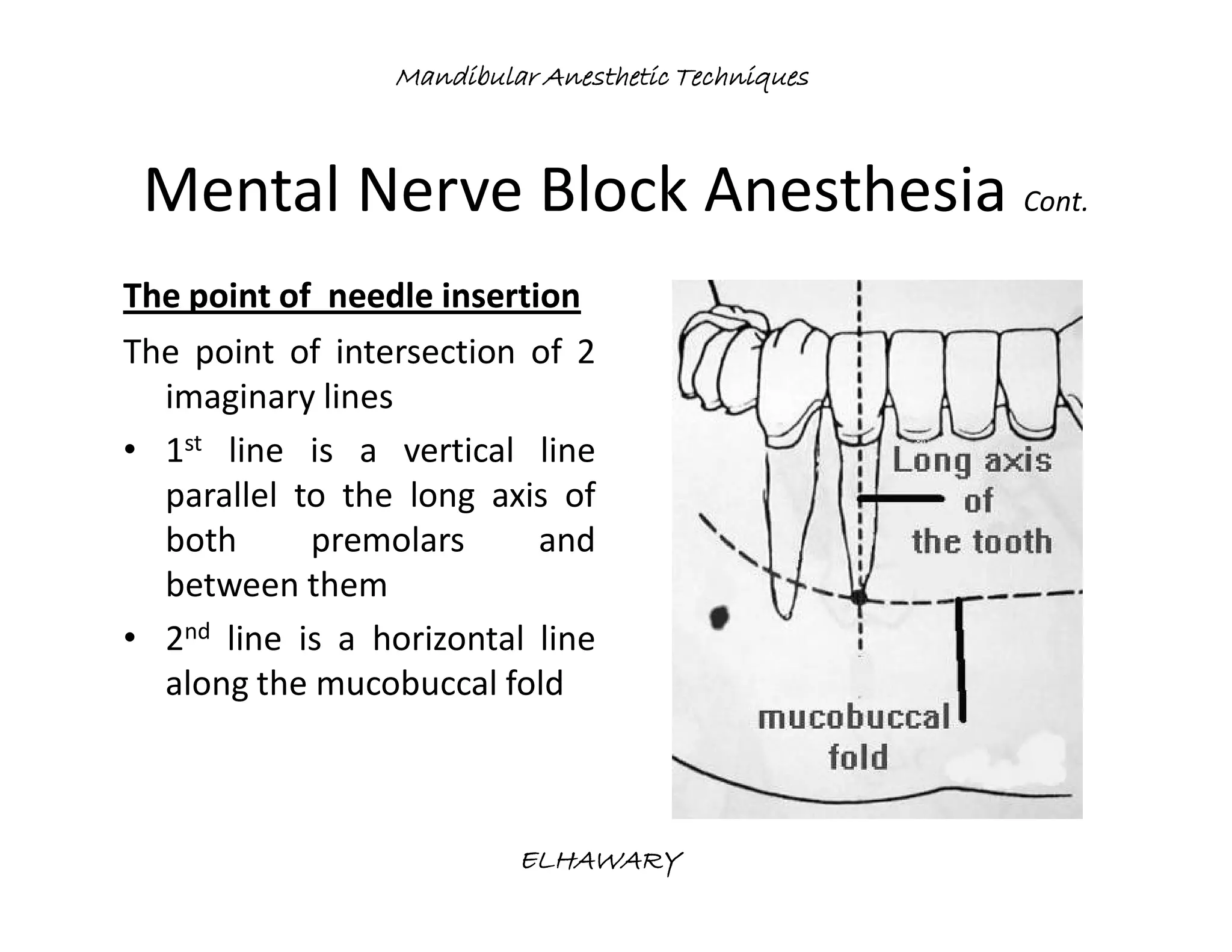 Mandibular anesthetic techniques | PDF