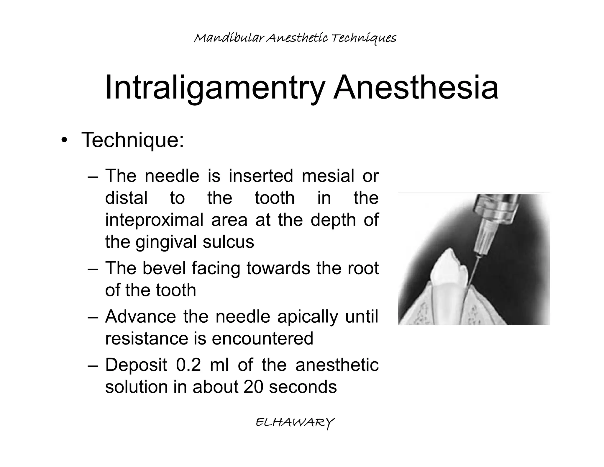 Mandibular anesthetic techniques | PDF