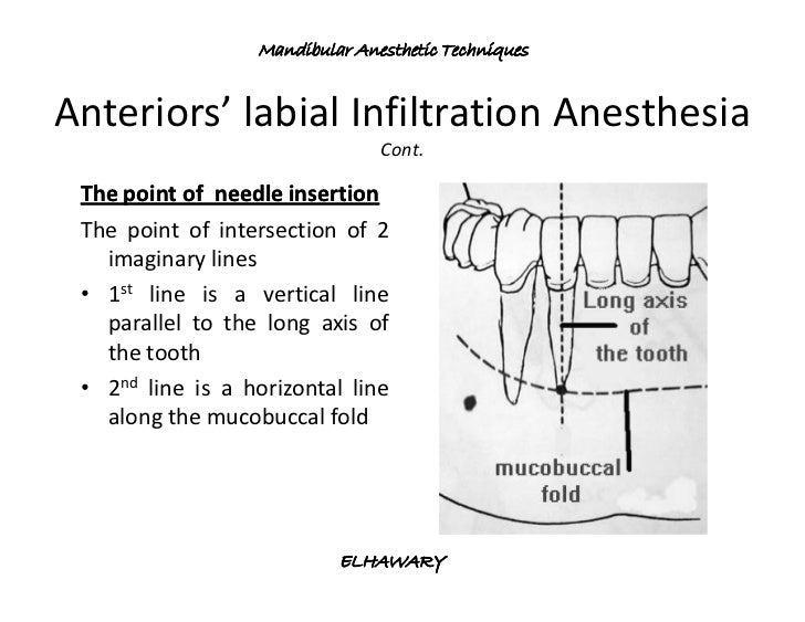 Mandibular anesthetic techniques