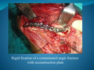 Rigid fixation of a comminuted angle fracture
with reconstruction plate
 