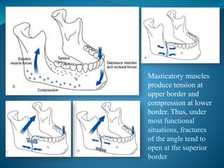 Masticatory muscles
produce tension at
upper border and
compression at lower
border. Thus, under
most functional
situations, fractures
of the angle tend to
open at the superior
border
 