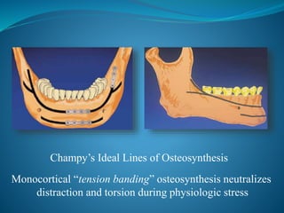 Champy’s Ideal Lines of Osteosynthesis
Monocortical “tension banding” osteosynthesis neutralizes
distraction and torsion during physiologic stress
 