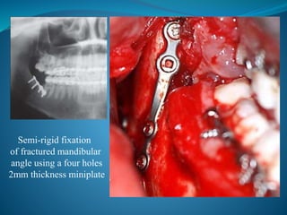 Semi-rigid fixation
of fractured mandibular
angle using a four holes
2mm thickness miniplate
 