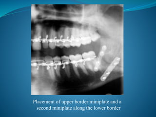 Placement of upper border miniplate and a
second miniplate along the lower border
 