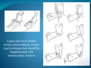 Upper and lower border
wiring osteosynthesis. A non-
rigid technique that should be
Supplemented with
intermaxillary fixation
 