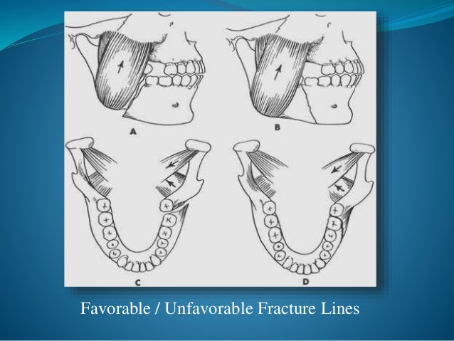 Favorable Mandibular Fracture