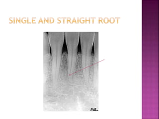 Permanent Mandibular Central Incisor