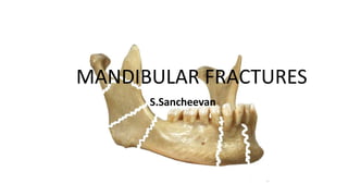MANDIBULAR FRACTURES 
S.Sancheevan 
 