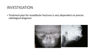 INVESTIGATION
• Treatment plan for mandibular fractures is very dependent on precise
radiological diagnosis
 
