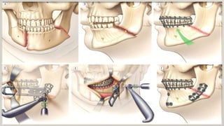 Mandibularfracture 131118111112-phpapp02
