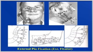 Mandibularfracture 131118111112-phpapp02