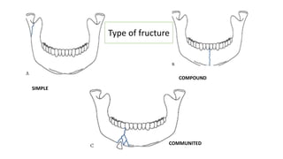 SIMPLE
COMPOUND
COMMUNITED
Type of fructure
 