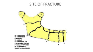 SITE OF FRACTURE
A- CONDYLAR
B- CORONOID
C-RAMUS
D- ANGLE
E- BODY(MOLAR
PREMOLAR AREAS
F- PARASYMPHYSIS
G- SYMPHYSIS
H-DENTO-ALVEOLAR
 
