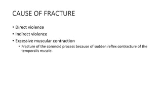 CAUSE OF FRACTURE
• Direct violence
• Indirect violence
• Excessive muscular contraction
• Fracture of the coronoid process because of sudden reflex contracture of the
temporalis muscle.
 