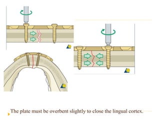 Mandibular fracture | PPTX