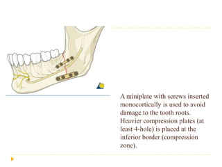 Mandibular fracture | PPTX