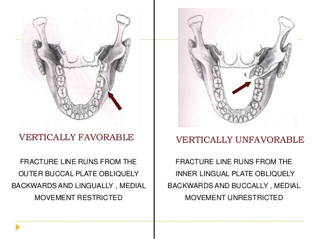 Pathway Fraktur Mandibula