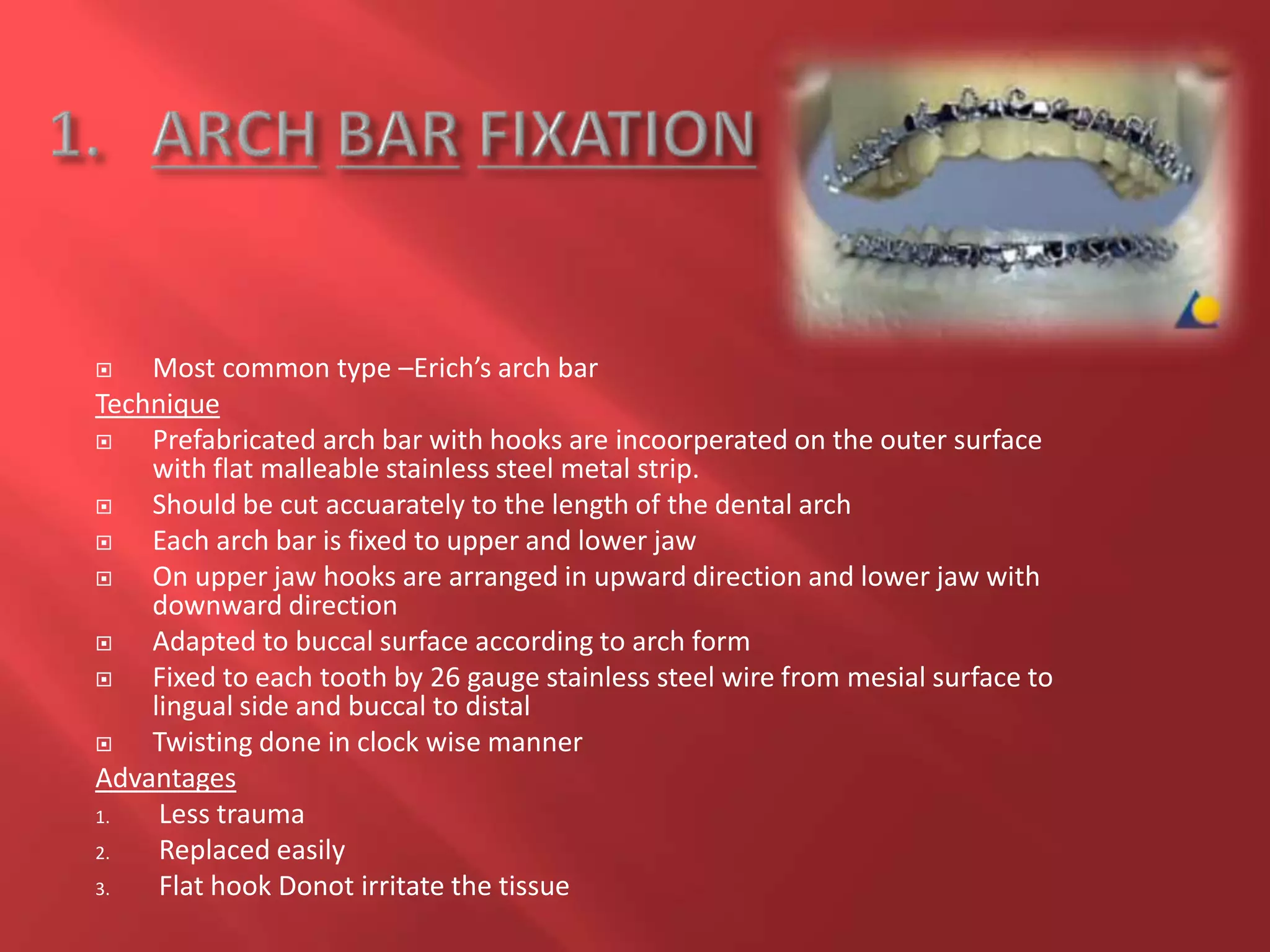  Most common type –Erich’s arch bar
Technique
 Prefabricated arch bar with hooks are incoorperated on the outer surface
with flat malleable stainless steel metal strip.
 Should be cut accuarately to the length of the dental arch
 Each arch bar is fixed to upper and lower jaw
 On upper jaw hooks are arranged in upward direction and lower jaw with
downward direction
 Adapted to buccal surface according to arch form
 Fixed to each tooth by 26 gauge stainless steel wire from mesial surface to
lingual side and buccal to distal
 Twisting done in clock wise manner
Advantages
1. Less trauma
2. Replaced easily
3. Flat hook Donot irritate the tissue
 