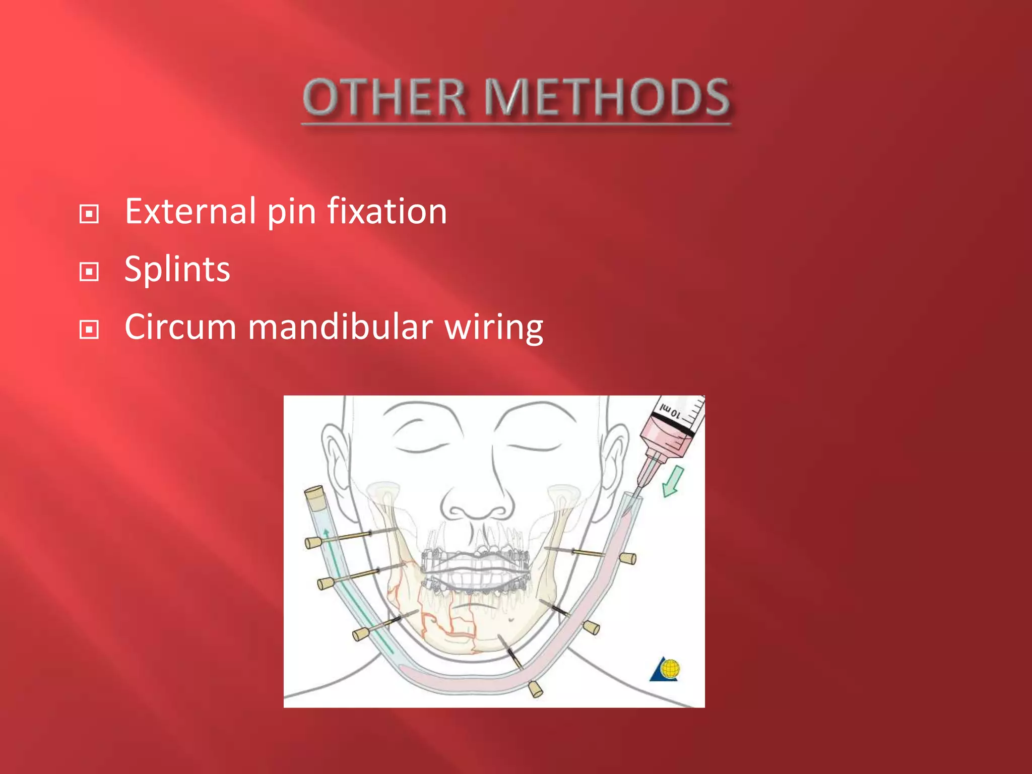  External pin fixation
 Splints
 Circum mandibular wiring
 