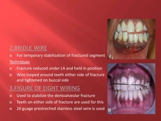 2.BRIDLE WIRE
 For temporary stabilization of fractured segment
Techniques
 Fracture reduced under LA and held in position
 Wire looped around teeth either side of fracture
and tightened on buccal side
3.FIGURE OF EIGHT WIRING
 Used to stabilize the dentoalveolar fracture
 Teeth on either side of fracture are used for this
 26 guage prestreched stainless steel wire is used
 