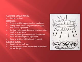 4.GILMERS DIRECT WIRING
 Simple method
Techniques
 Prestreched 26 gauge stainless steel wire
 Wire passed around single tooth in upper
arch till it is tightened
 Similiarly wire passed around corresponding
tooth in lower arch
 Teeth are brought in occlusion and twisted
wires are held together tightened
 Done in fast immobilization is required
5.RISDON WIRING
 Substitute for arch bars
 Second premolars on either sides are chosen
for anchorage
 