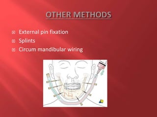  External pin fixation
 Splints
 Circum mandibular wiring
 