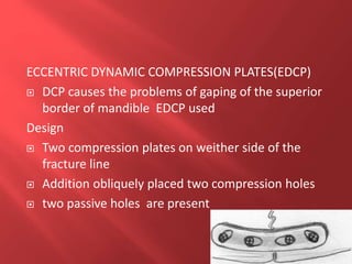 ECCENTRIC DYNAMIC COMPRESSION PLATES(EDCP)
 DCP causes the problems of gaping of the superior
border of mandible EDCP used
Design
 Two compression plates on weither side of the
fracture line
 Addition obliquely placed two compression holes
 two passive holes are present
 
