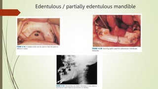 Edentulous / partially edentulous mandible
 