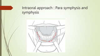 Intraoral approach : Para symphysis and
symphysis
 