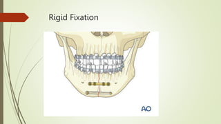 Rigid Fixation
 